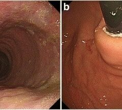 Surgical management for achalasia