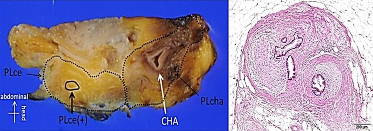 Amostra cirúrgica de carcinoma pancreático irressecável e coloração h&e