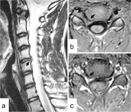 Symptomatic cervical disc herniation in teenagers