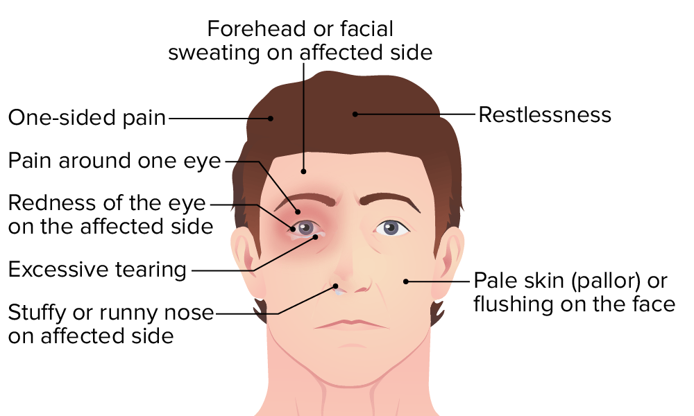 Symptoms of cluster headache