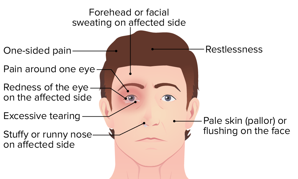 Types Of Headaches and How To Get Rid Of Them The Healthy 51 OFF