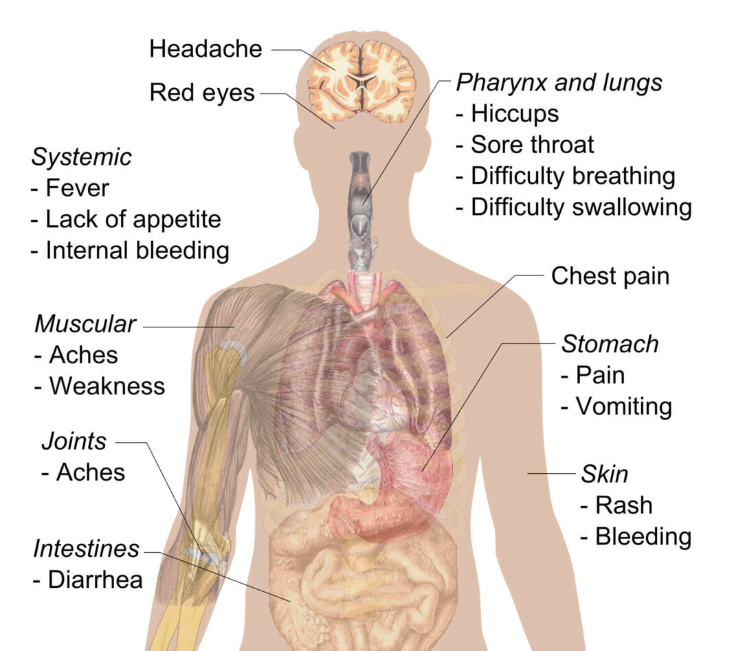 Symptoms of ebola