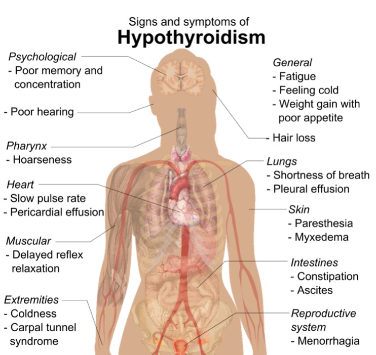 Hypothyroidism  Concise Medical Knowledge