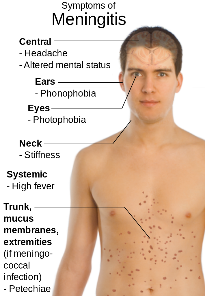 Sintomas de meningite