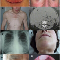 Systemic and manifestations of AL amyloidosis