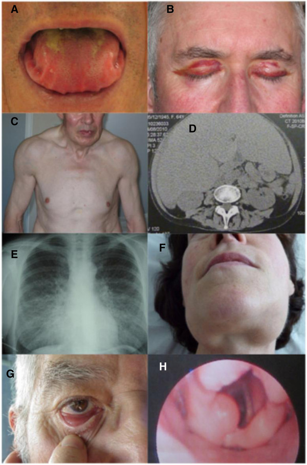 Systemic and manifestations of al amyloidosis