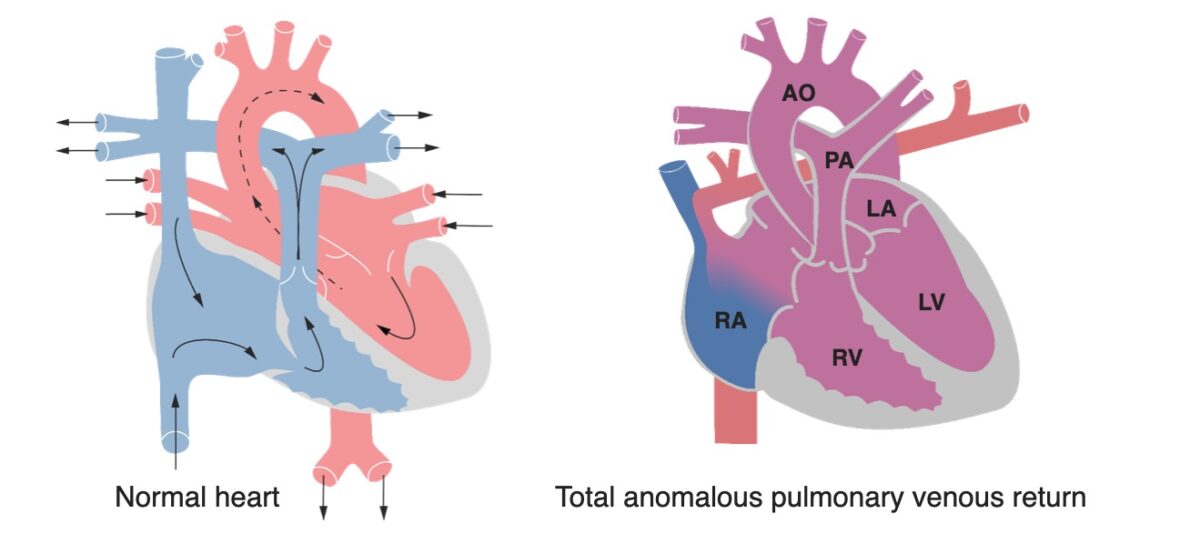 Tavr vs normal heart