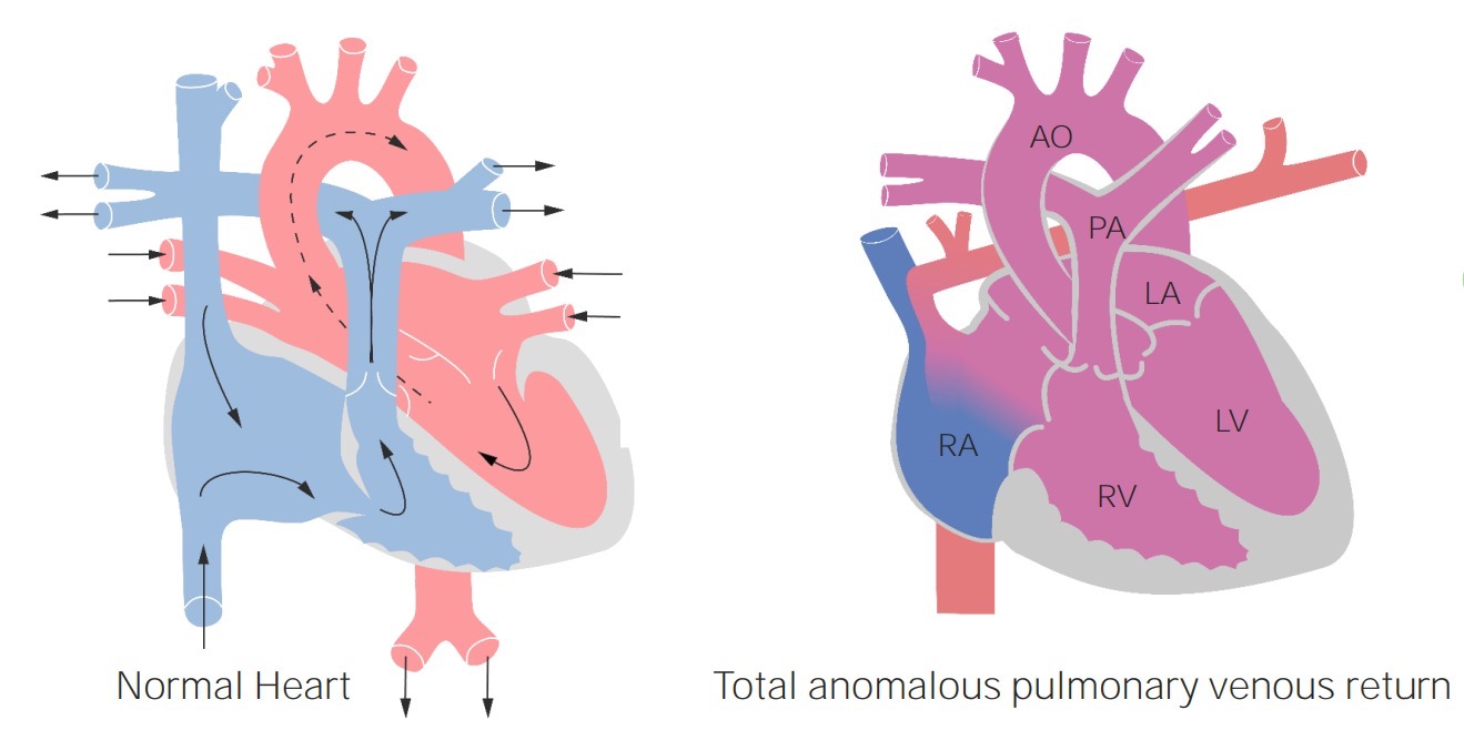 Total Anomalous Pulmonary Venous Return (TAPVR) | Concise Medical Knowledge