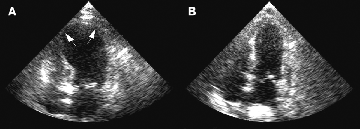 Takotsubo ultrasound