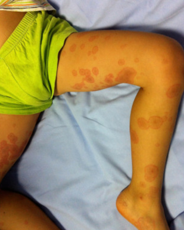 Target lesions of erythema multiforme, which may be a manifestation of a drug eruption.