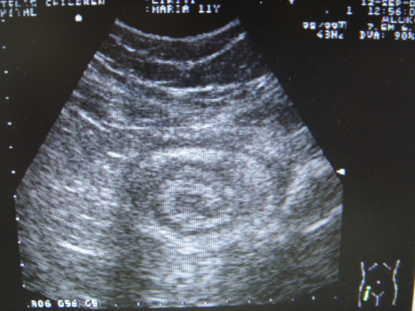 Sinal alvo típico de intussuscepção na ultrassonografia abdominal