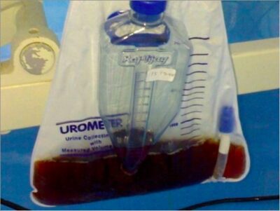 Tea coloured urine due to rhabdomyolysis