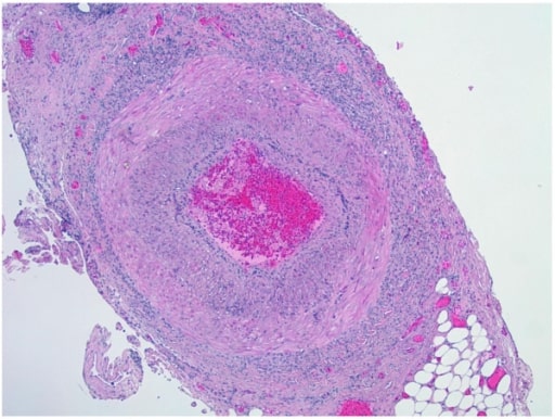 Arteritis de células gigantes