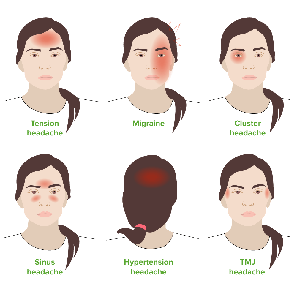 Tension Headaches | Concise Medical Knowledge