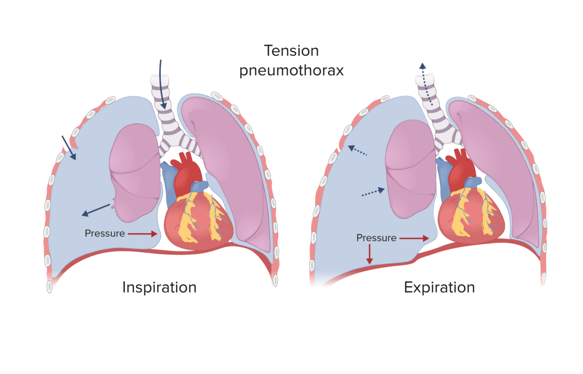 Tension pneumothorax (pneumotórax hipertensivo)
