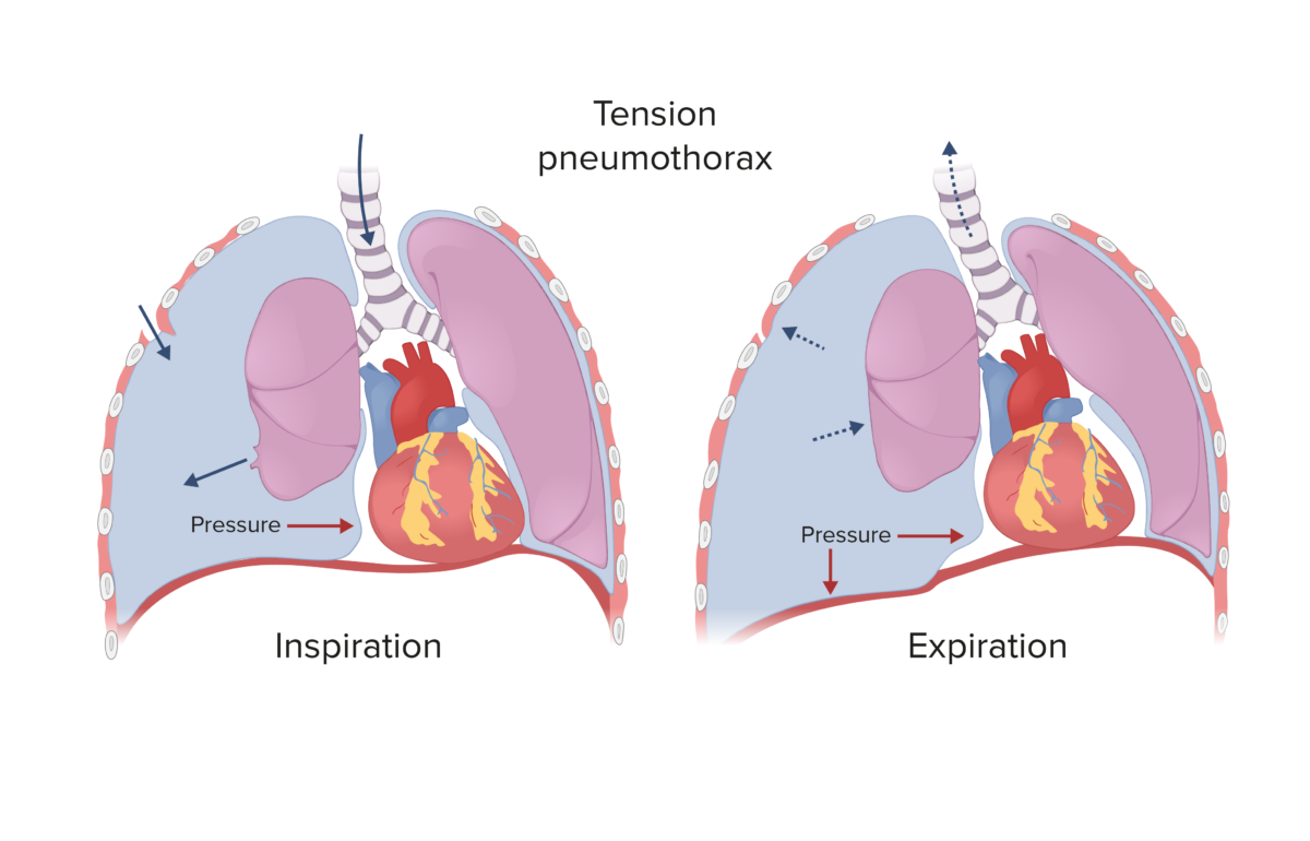 Tension pneumothorax