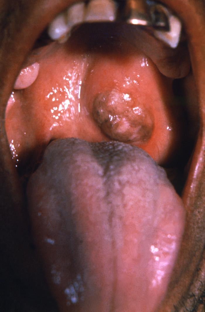Tertiary syphilis gumma