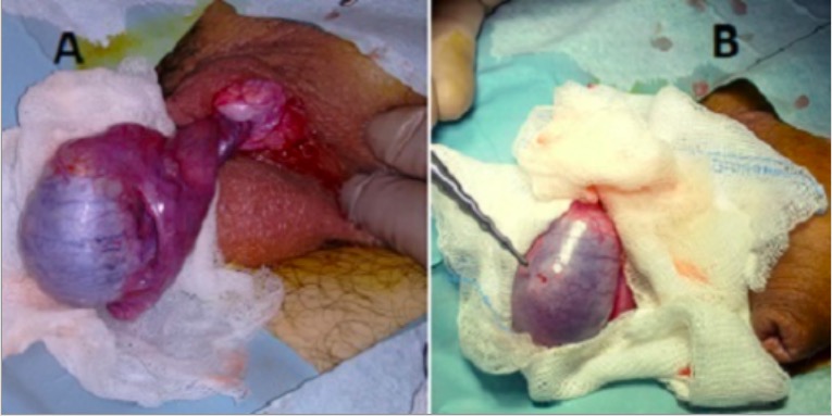 Cirugía de torsión testicular
