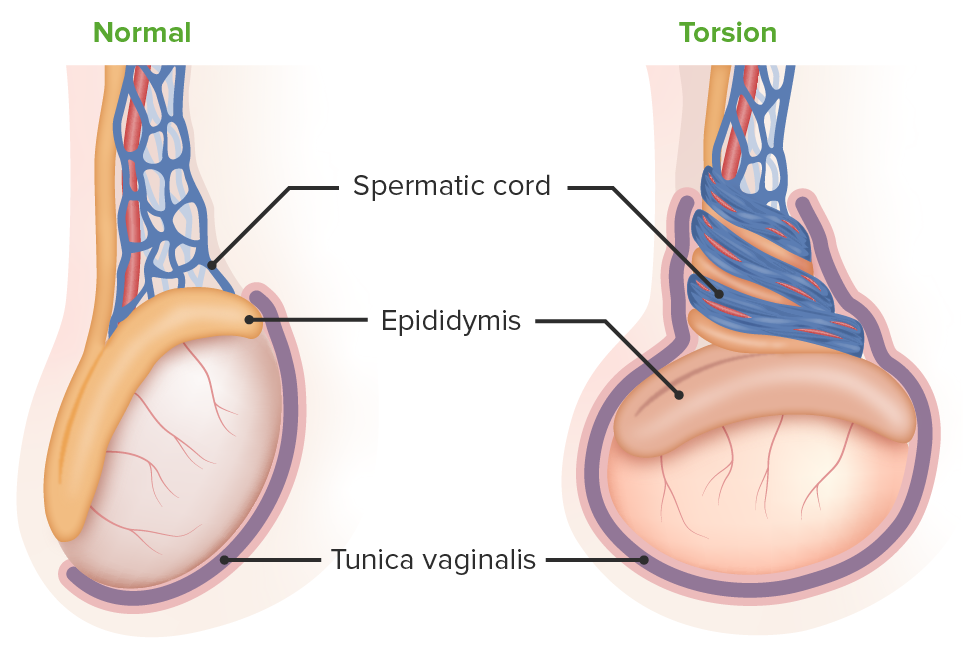 Torção testicular