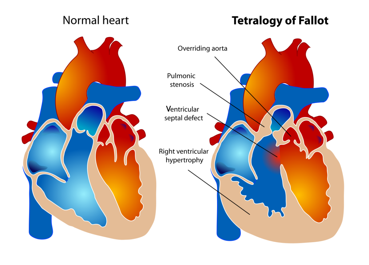 Tetralogía de fallot