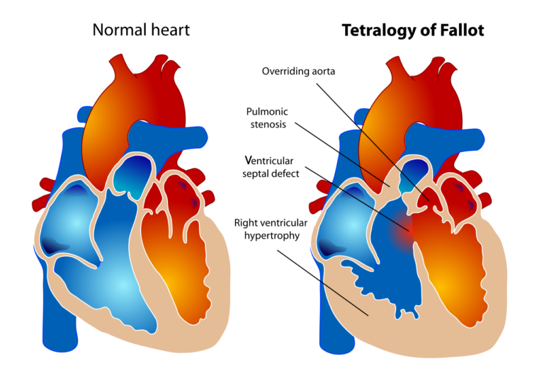 Pulmonary Stenosis | Concise Medical Knowledge