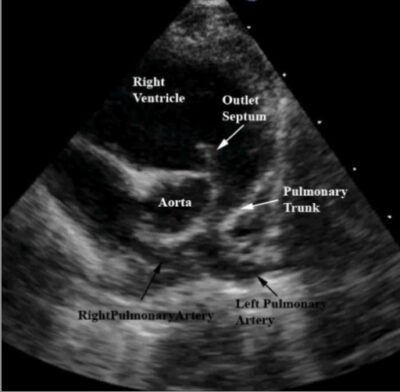 Tetralogy of Fallot | Concise Medical Knowledge