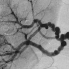 The string-of-beads feature in medial fibromuscular dysplasia