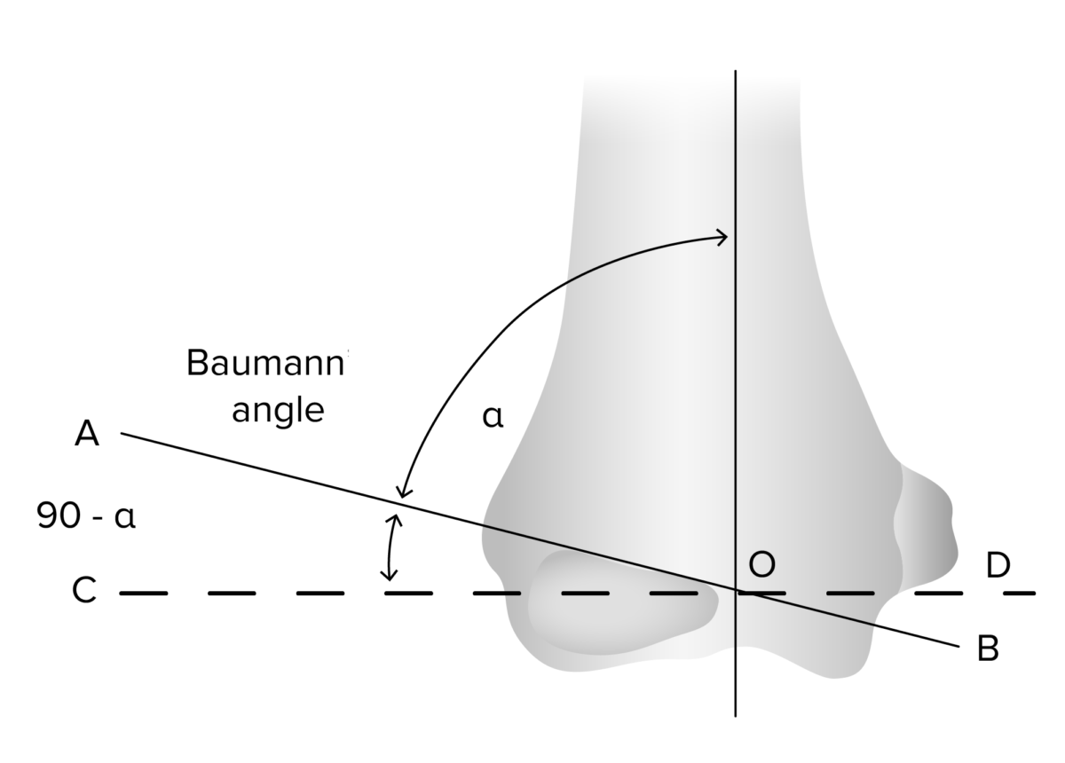 The baumann angle