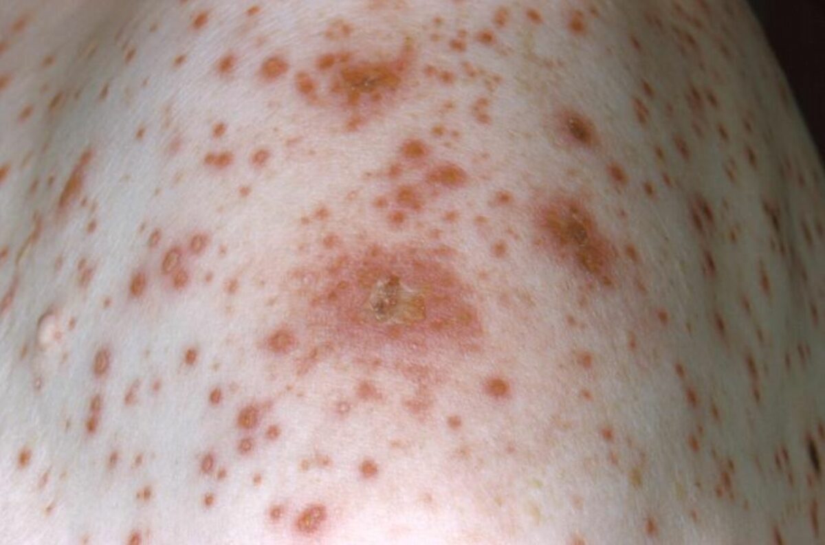 The classic rash of chickenpox with lesions in different stages of evolution.
