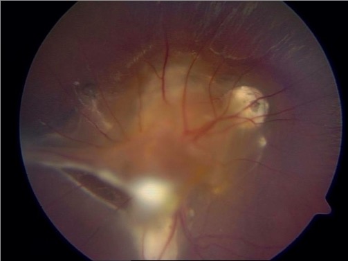 The co-occurrence of toxocara ocular and visceral larva migrans