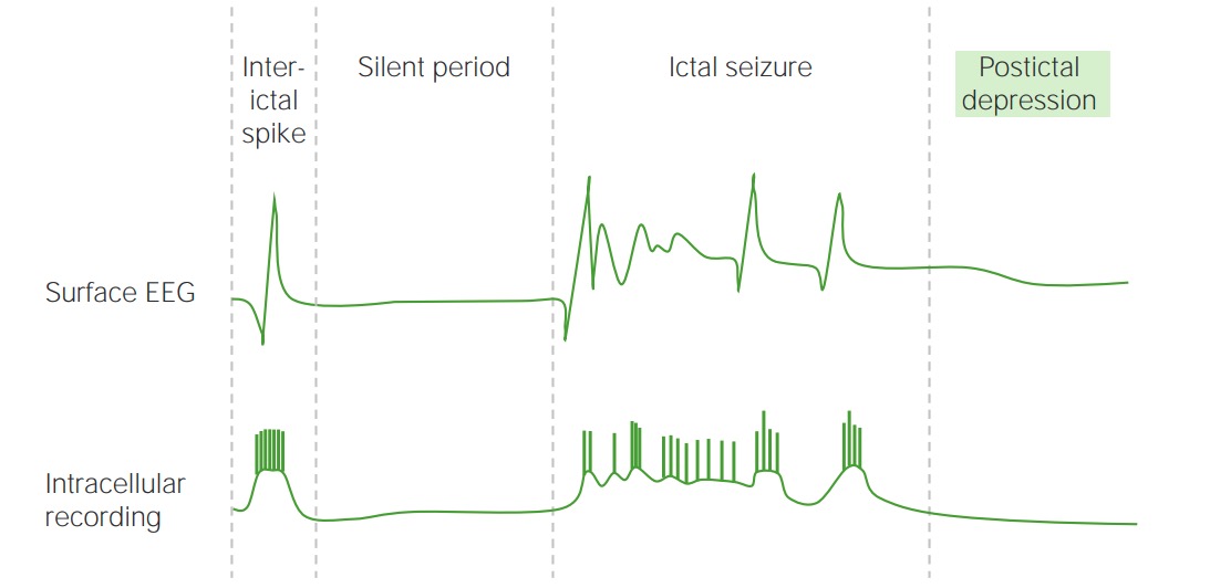 Electrical activity of the brain on an eeg during a seizure