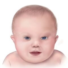 The facial features of a baby with Down syndrome