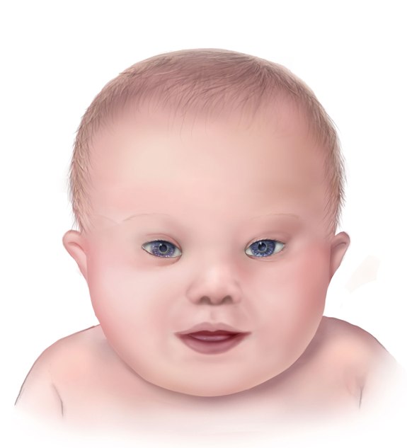 The facial features of a baby with down syndrome