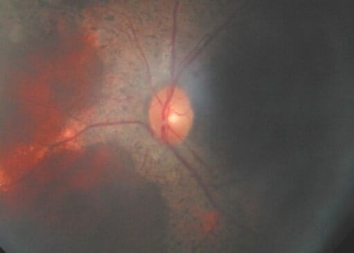 The fundus of an individual with cgd showing a retinal mass