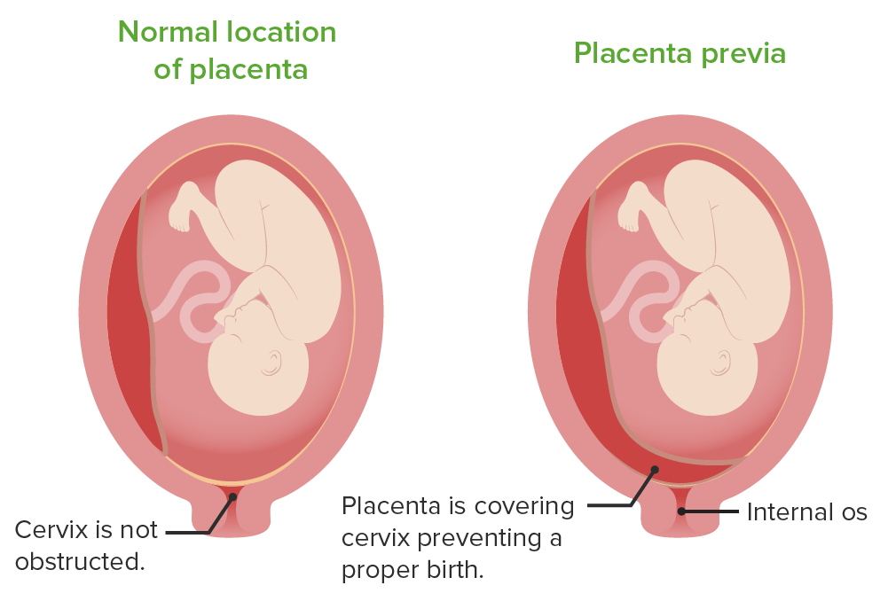 The location of the placenta in placenta previa