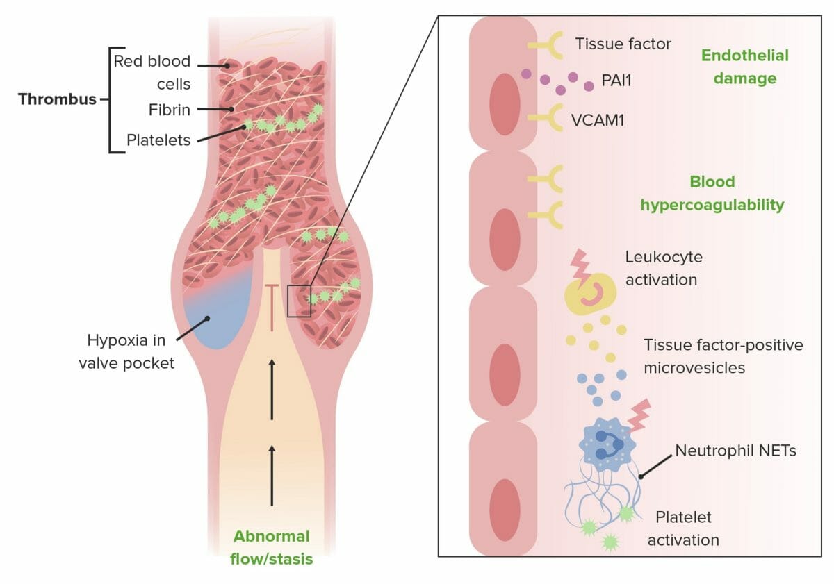 The main pathophysiologic mechanisms leading to deep vein thrombosis