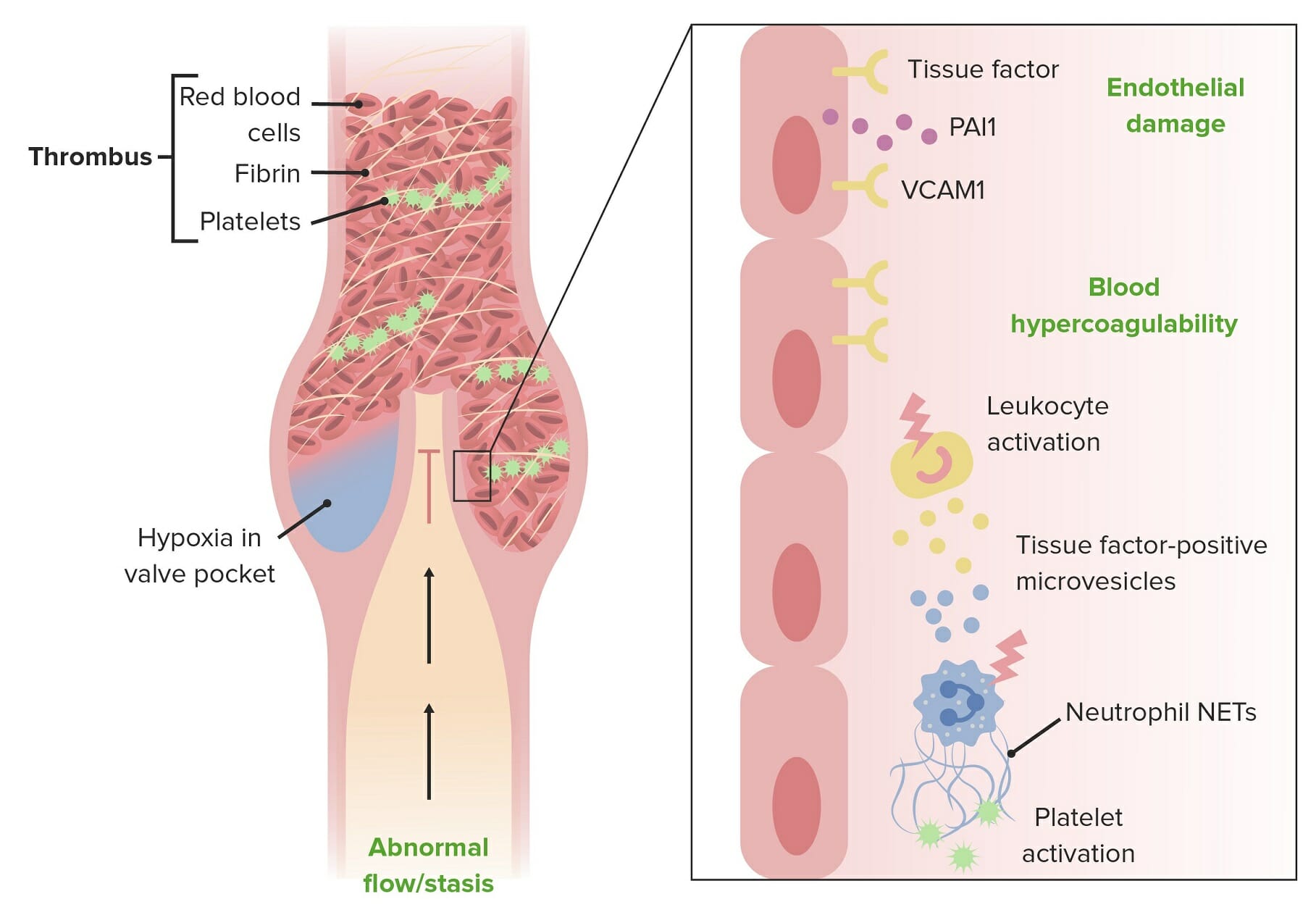 arterial thrombosis vs venous thrombosis