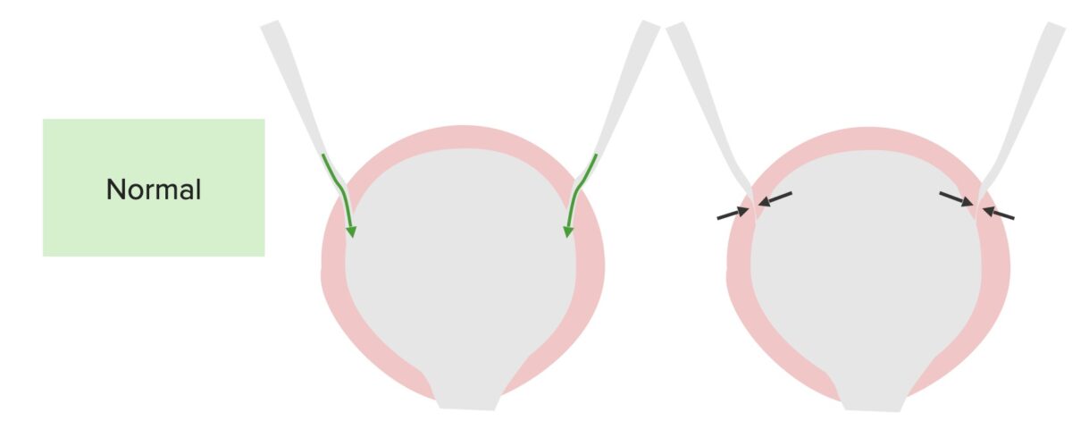 The normal function of the bladder and ureteres