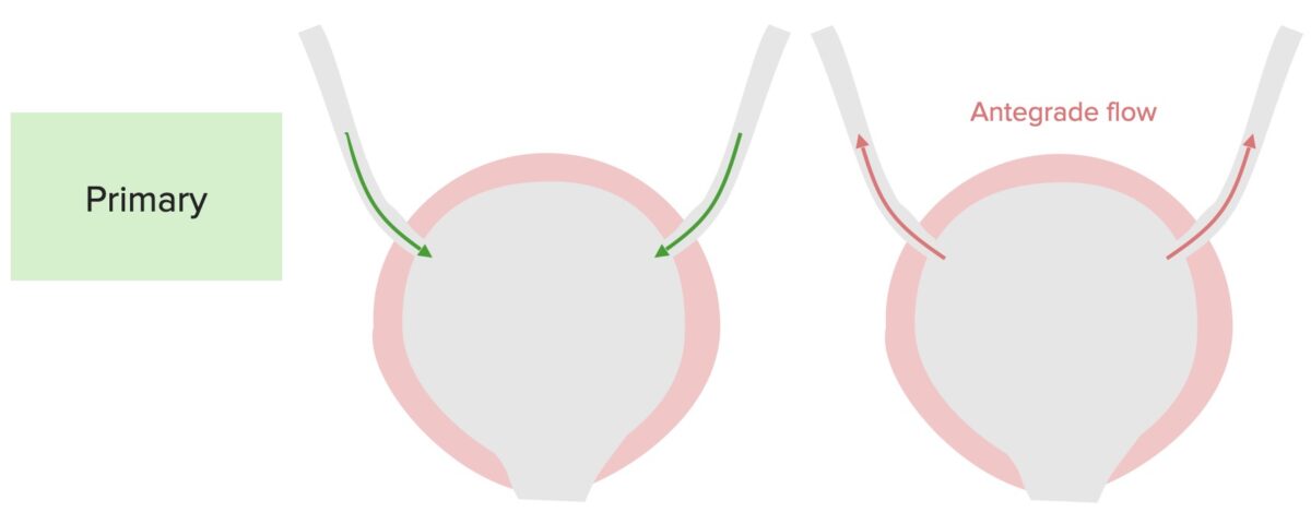 Fisiopatología del reflujo vesicoureteral primario