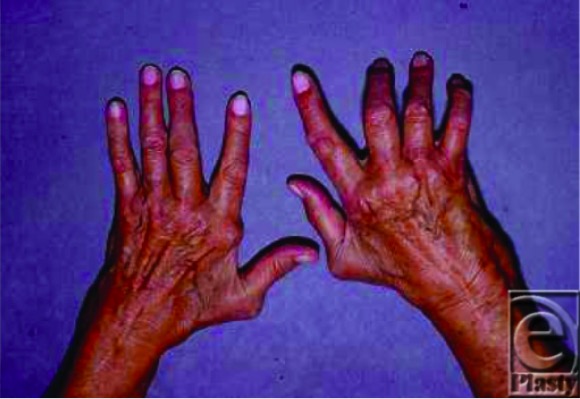 The rheumatoid hand