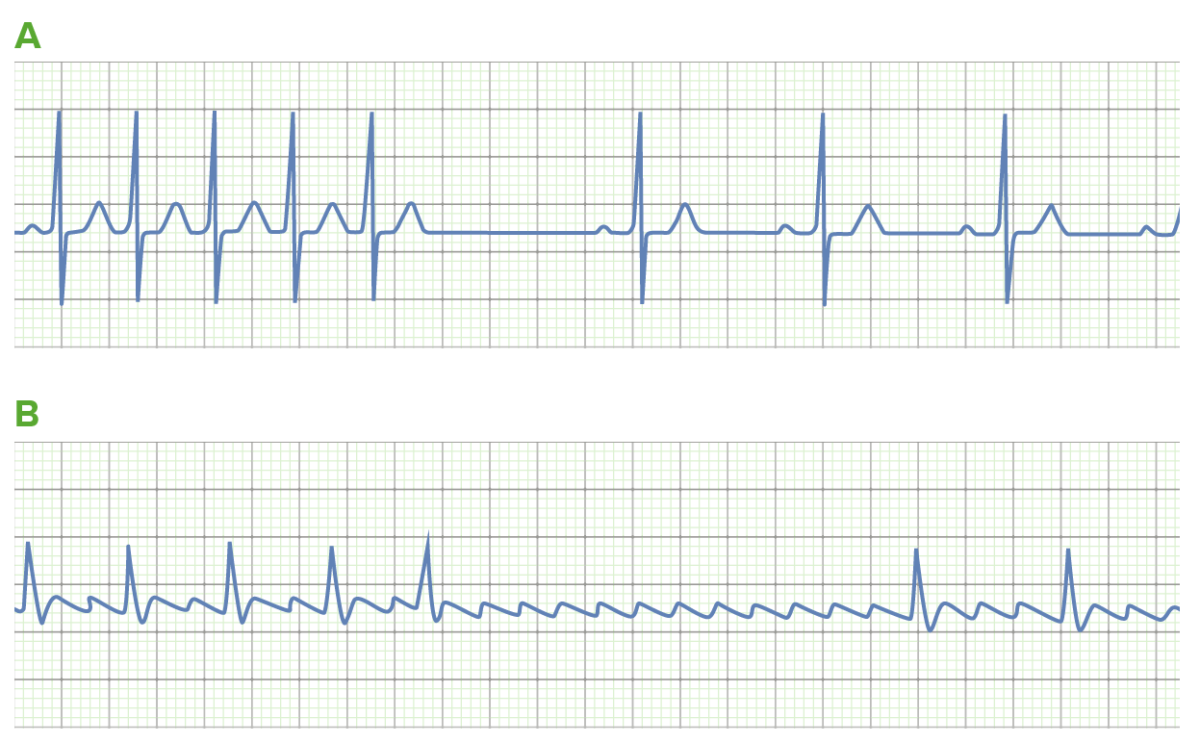 The use of adenosine in tachyarrhythmias class 5 antiarrythmics