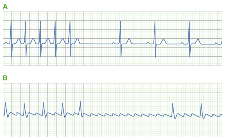 Class 5 Antiarrhythmic Drugs | Concise Medical Knowledge