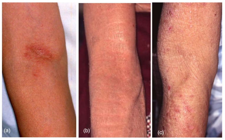 MÁCULAS ACASTANHADAS EM AXILAS E VIRILHAS? PODE SER ERITRASMA -  DermatoPapers