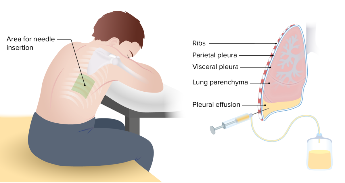 Pleural Effusion Concise Medical Knowledge