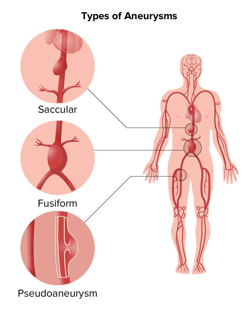 Modelo anatômico de aneurisma da aorta abdominal - 021 series