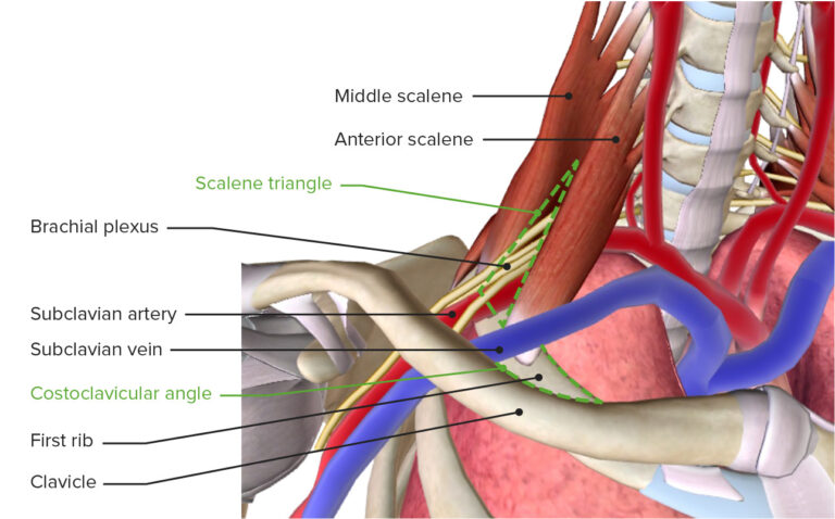 Thoracic Outlet Syndrome | Concise Medical Knowledge