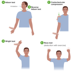 Thoracic Outlet Syndrome | Concise Medical Knowledge