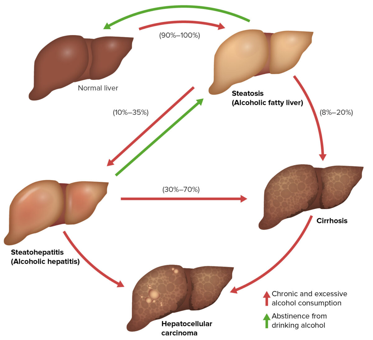 Three stages of alcoholic liver disease