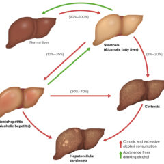 Three stages of alcoholic liver disease