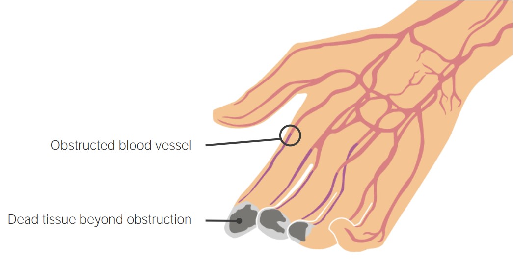 Arteriopatia periferică (arteriopatia obliterantă, arterita, boala arterială periferică)